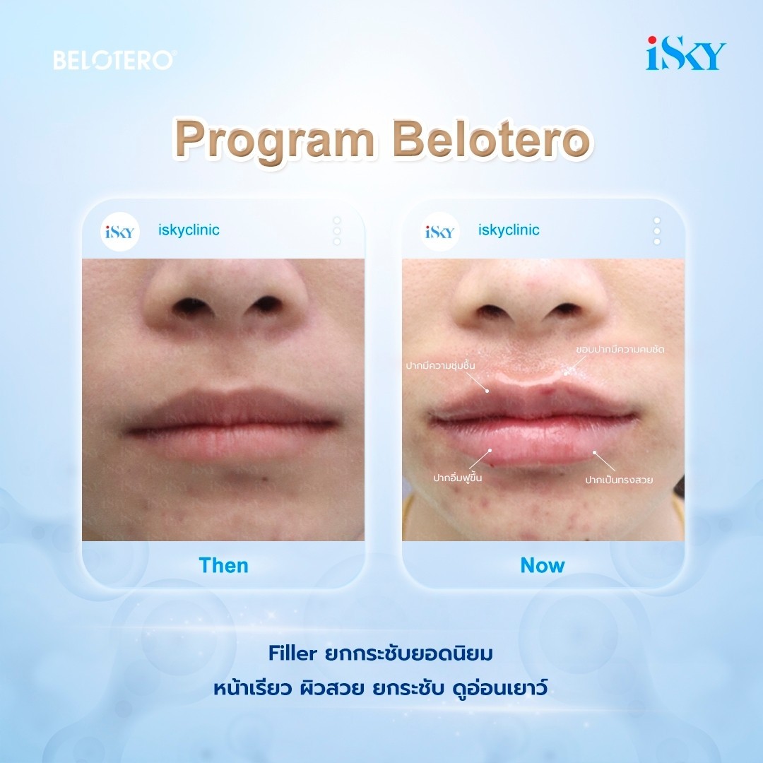 Filler Program