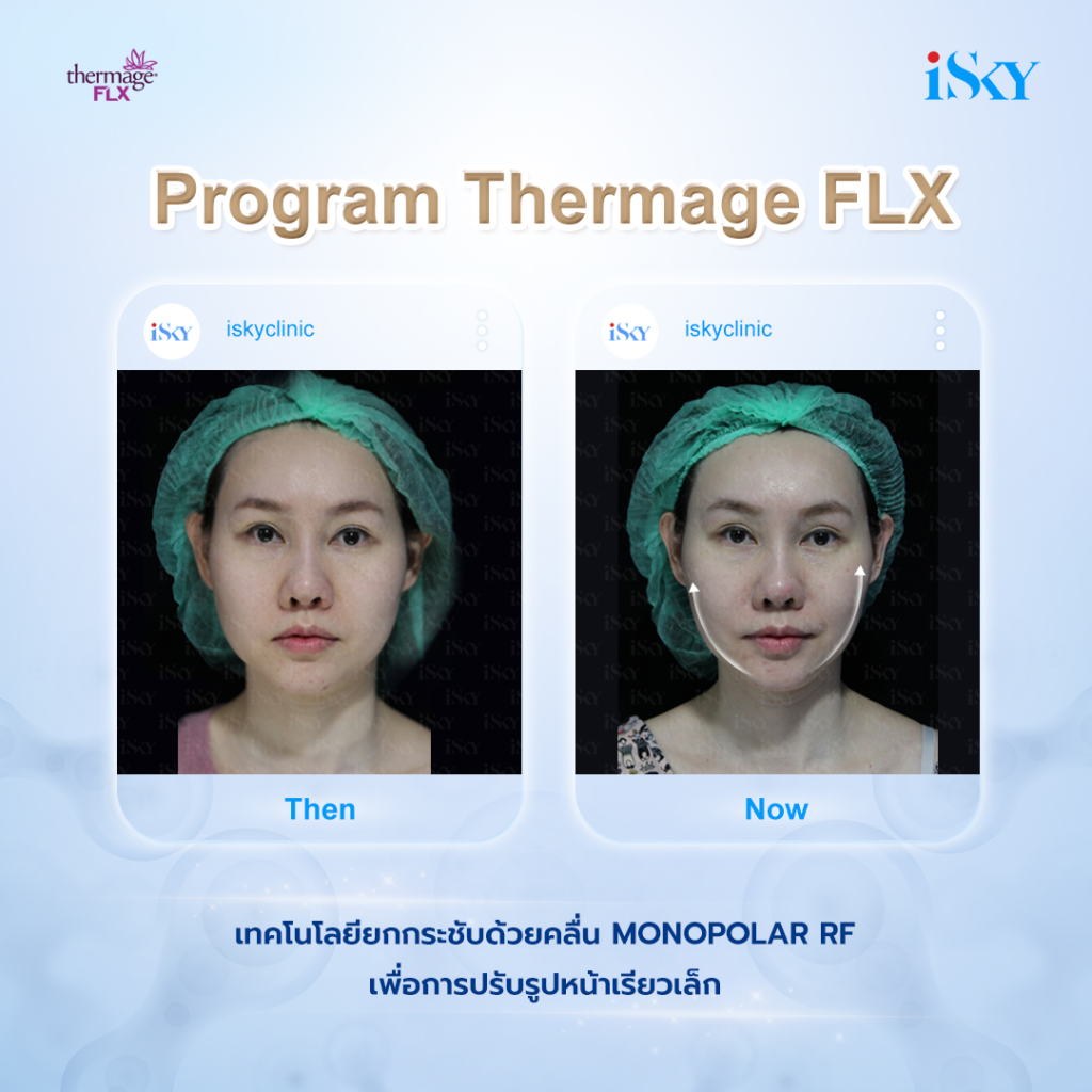 ยกกระชับผิวหน้าด้วย Thermage FLX ที่ iSKY Center ชิดลม